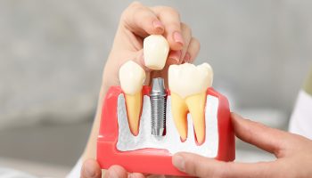 What Is The Procedure Of Dental Implants
