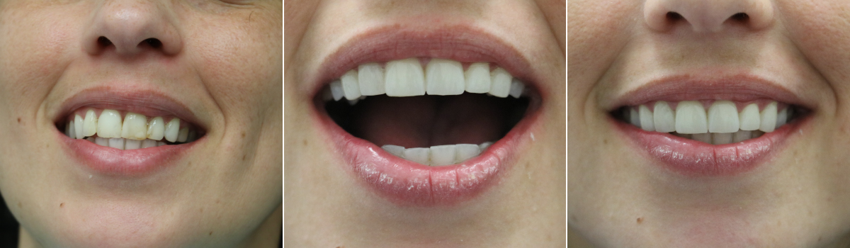 Treatment of Front top 6 teeth cosmetic crowns in FL