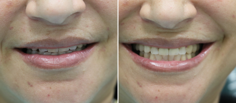 Treatment of Teeth Crowns for Smile Makeover in FL