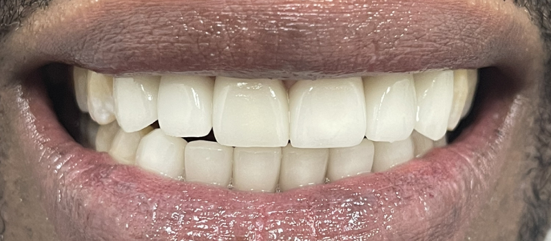 Treatment of Dental Crown - Perfect Dental