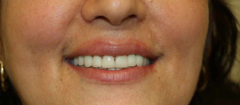 Treatment of Teeth crown and bridges in Brandon, FL