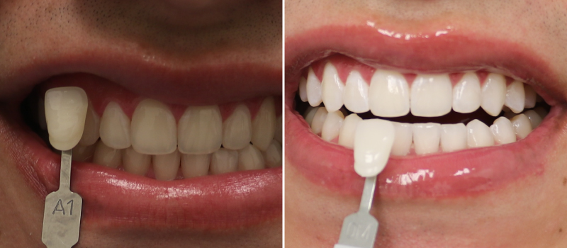 Zoom Teeth whitening Service - Brandon Perfect Dental