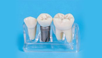 How to Know When You Need a Dental Crown: Signs and Symptoms to Watch For