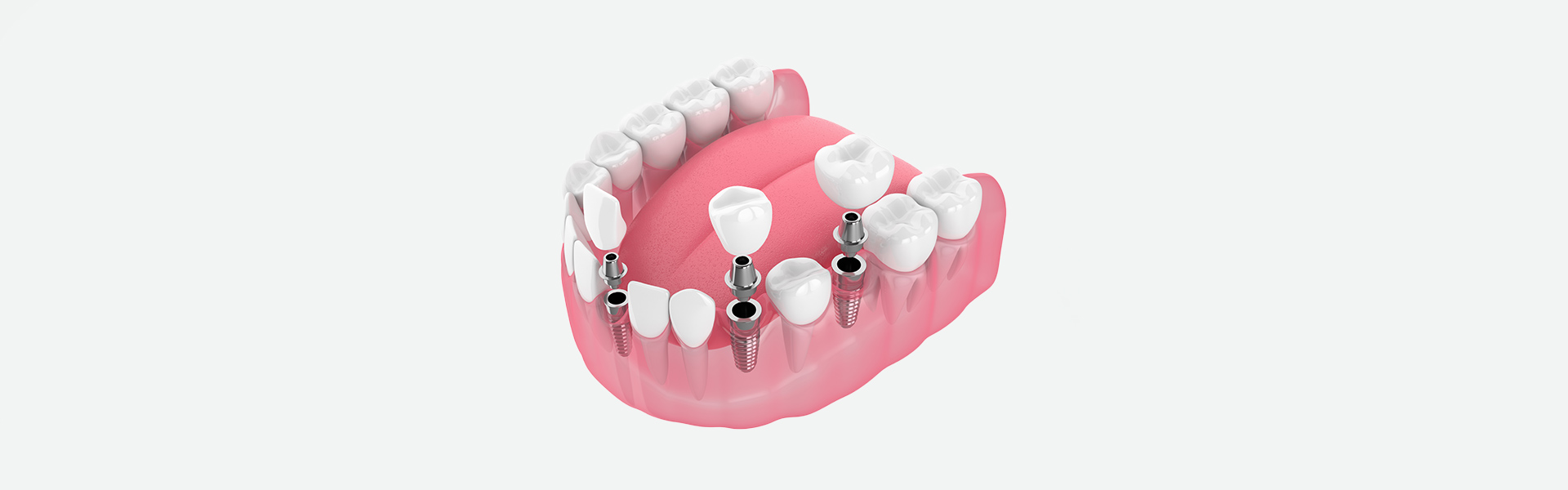 Boosting Your Confidence with a Custom Dental Bridge in Brandon