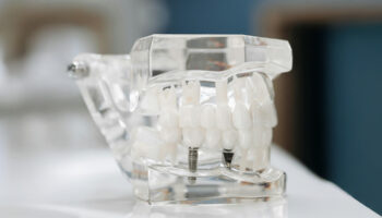 The Long-Term Benefits of Choosing Implants Over Bridges