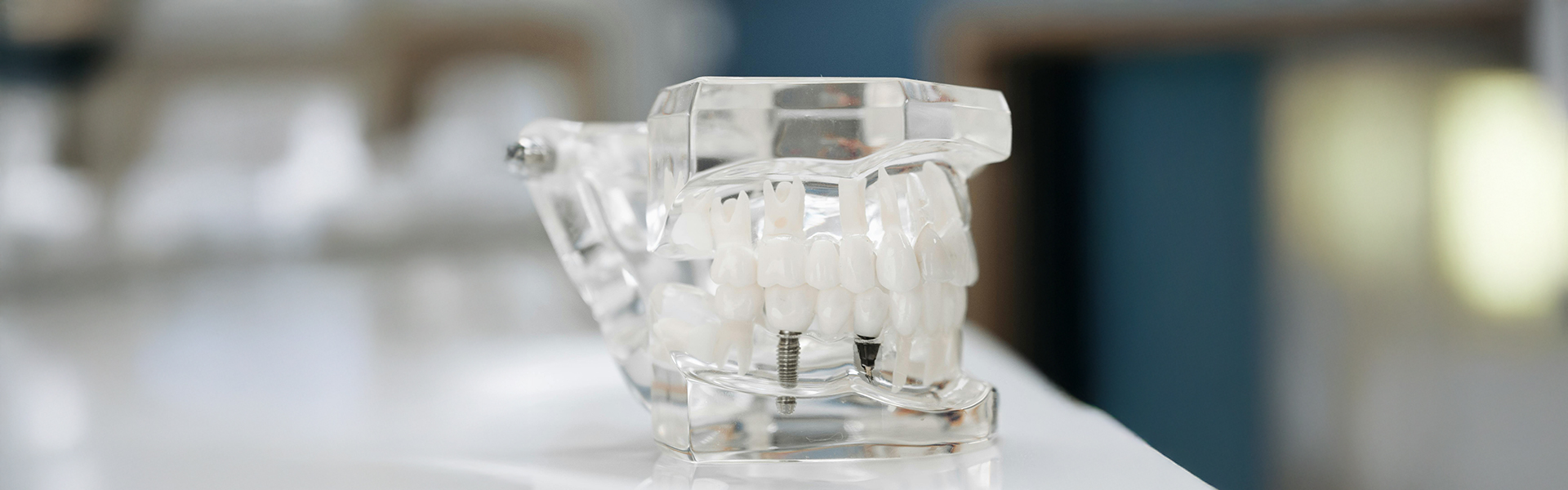 The Long-Term Benefits of Choosing Implants Over Bridges