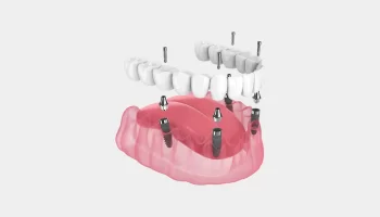 How to Care for Your All-on-4 Dental Implants